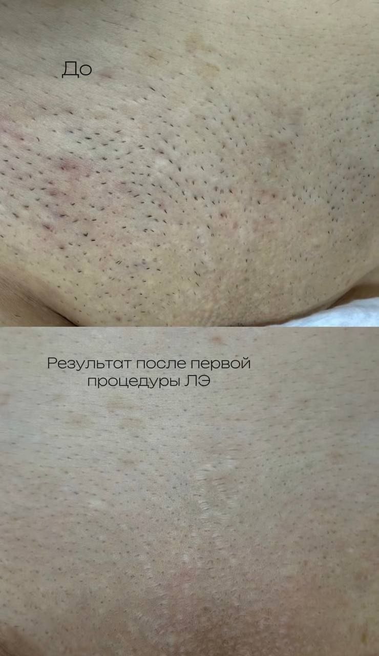 Лазерная эпиляция — результат после первой процедуры