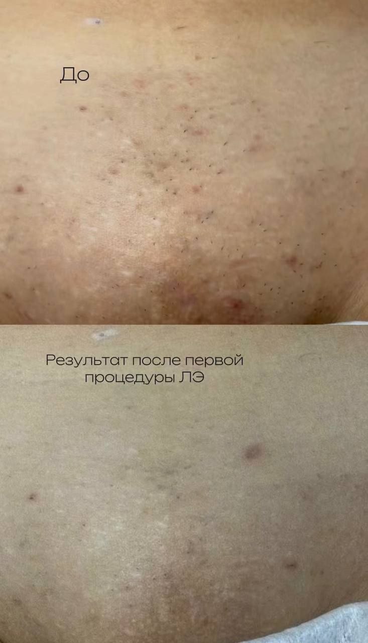Лазерная эпиляция — результат после первой процедуры
