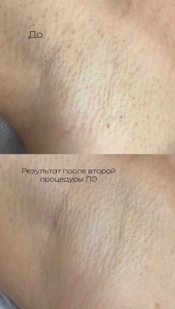Лазерная эпиляция подмышек — результат после второй процедуры